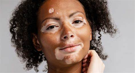 Vitiligo treatment in Hyderabad