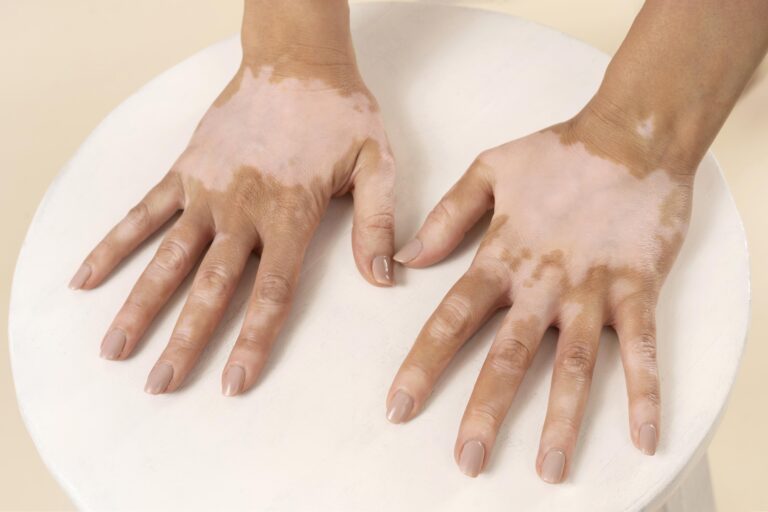 Best Vitiligo Treatment in Hyderabad –Restore Skin Naturally