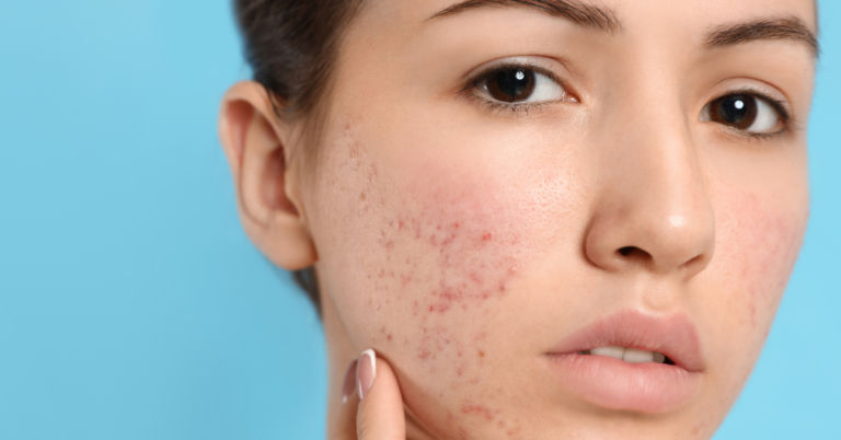 Say Goodbye to Acne with Ayurvedic Root-Level Solutions
