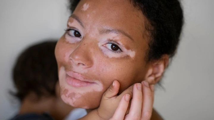 Natural Vitiligo Management – Re-Pigment Without Chemicals