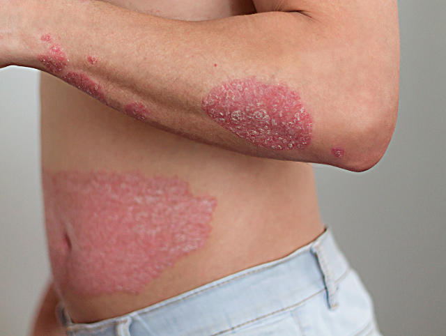 Healing Psoriasis the Ayurvedic Way – Long-Term Relief Without Steroids