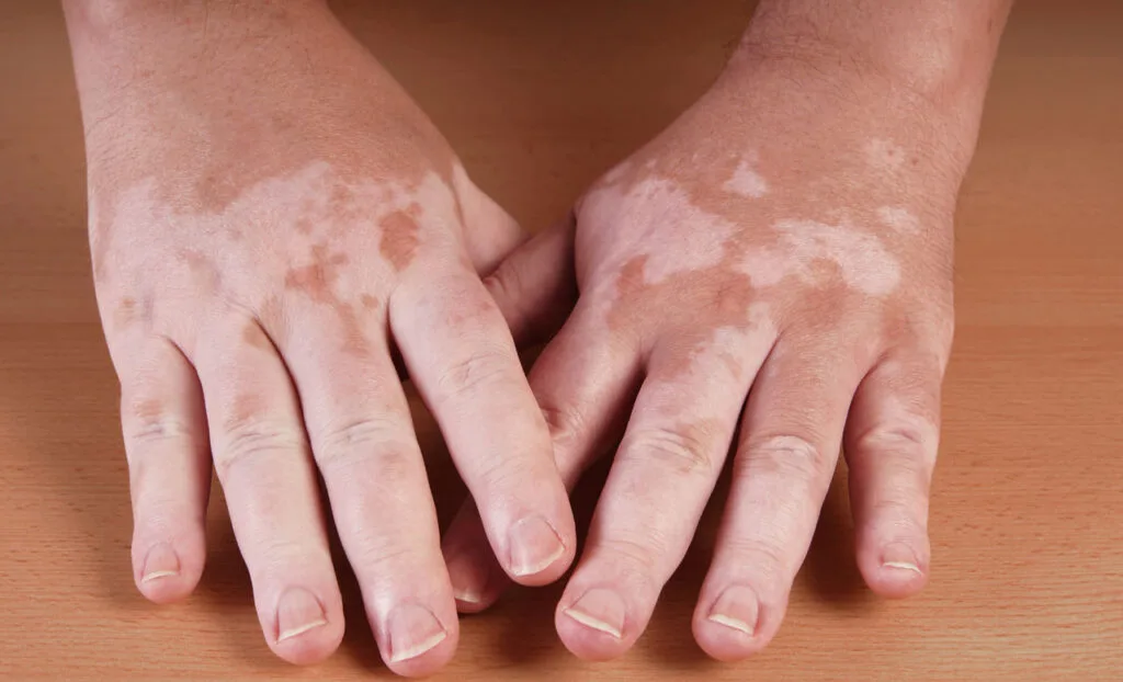 Ayurvedic Vitiligo and Psoriasis Treatment in Hyderabad - RK Ayurvedic Clinic