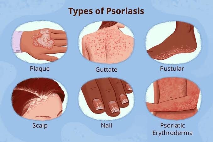 The Power of Herbs in Psoriasis Management