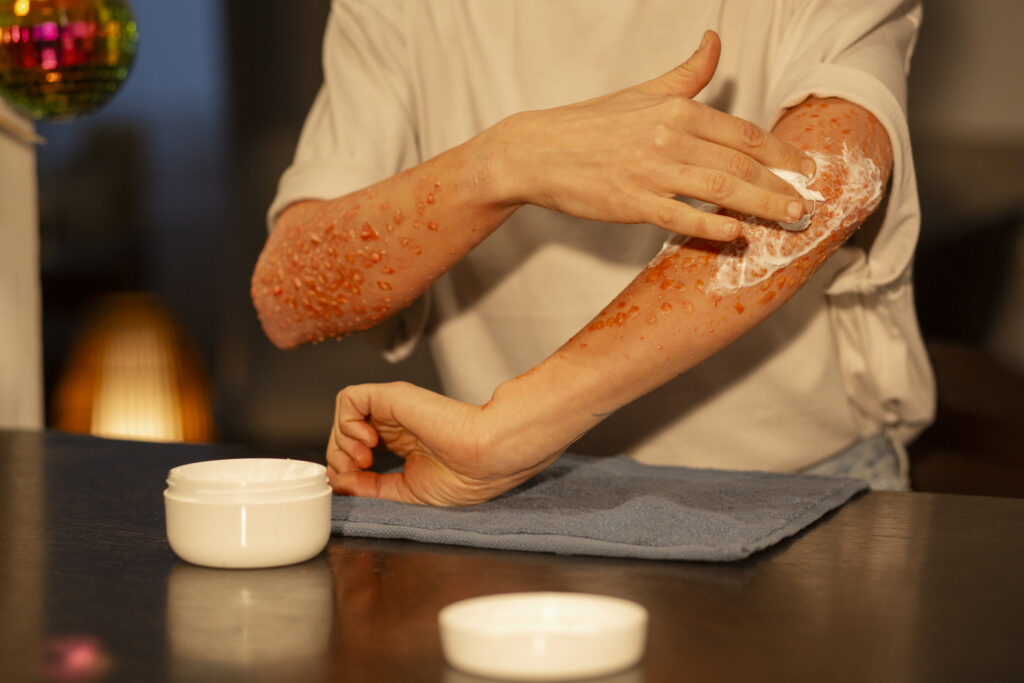 Best Ayurvedic psoriasis treatment clinic in KPHB Hyderabad