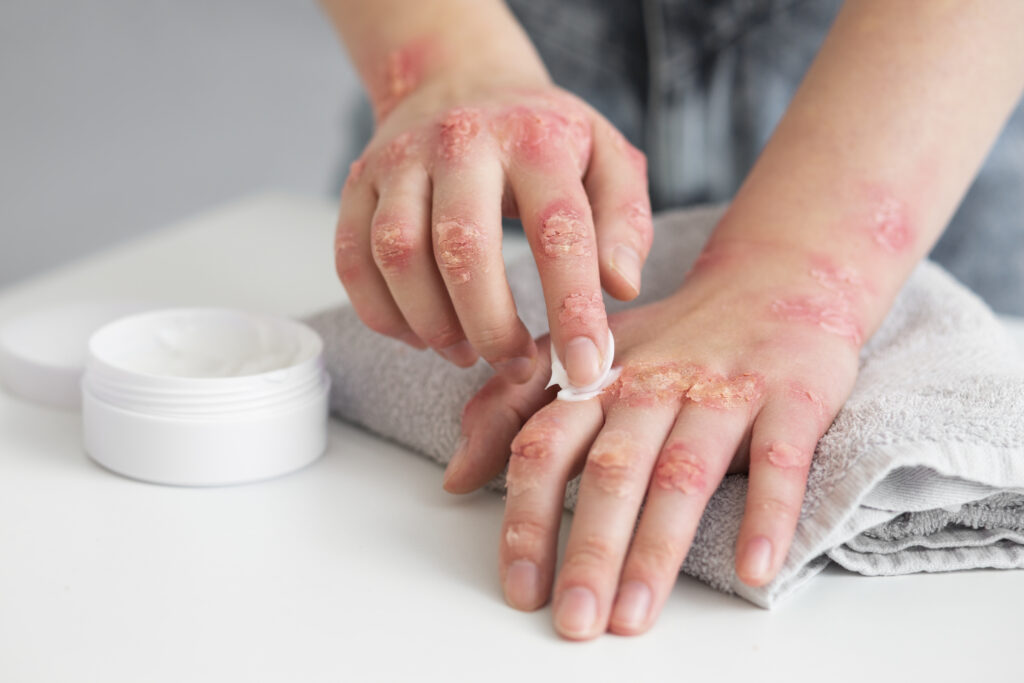 Affordable Psoriasis Solutions in Hyderabad
