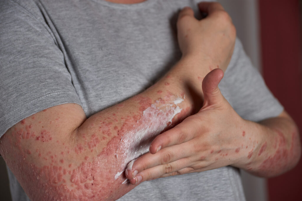 Skin Rash and Psoriasis Treatment in Warangal