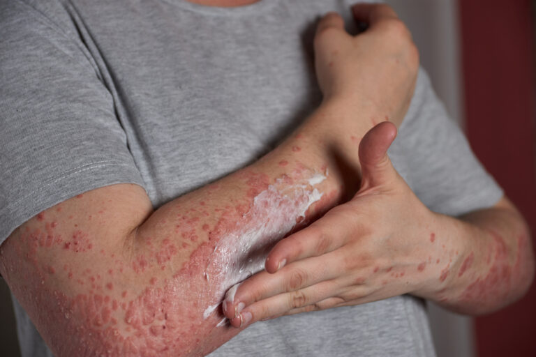 Skin Rash and Psoriasis Treatment in Warangal
