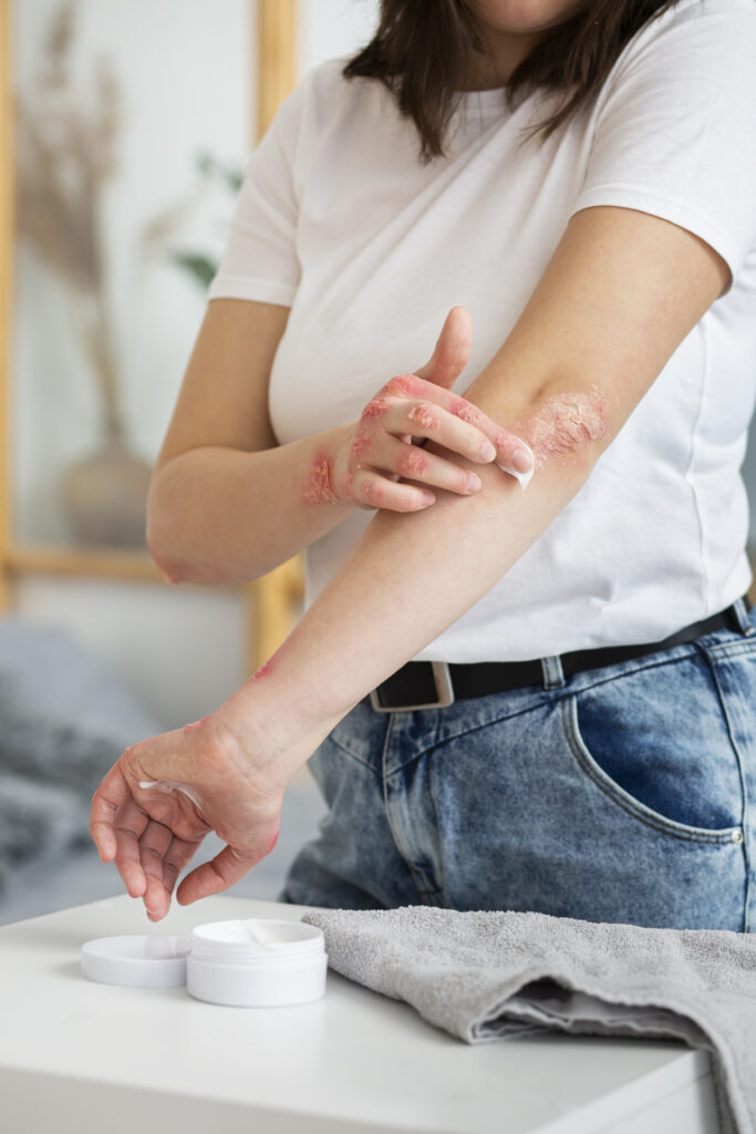 Ayurvedic Treatment for Dry Skin Psoriasis