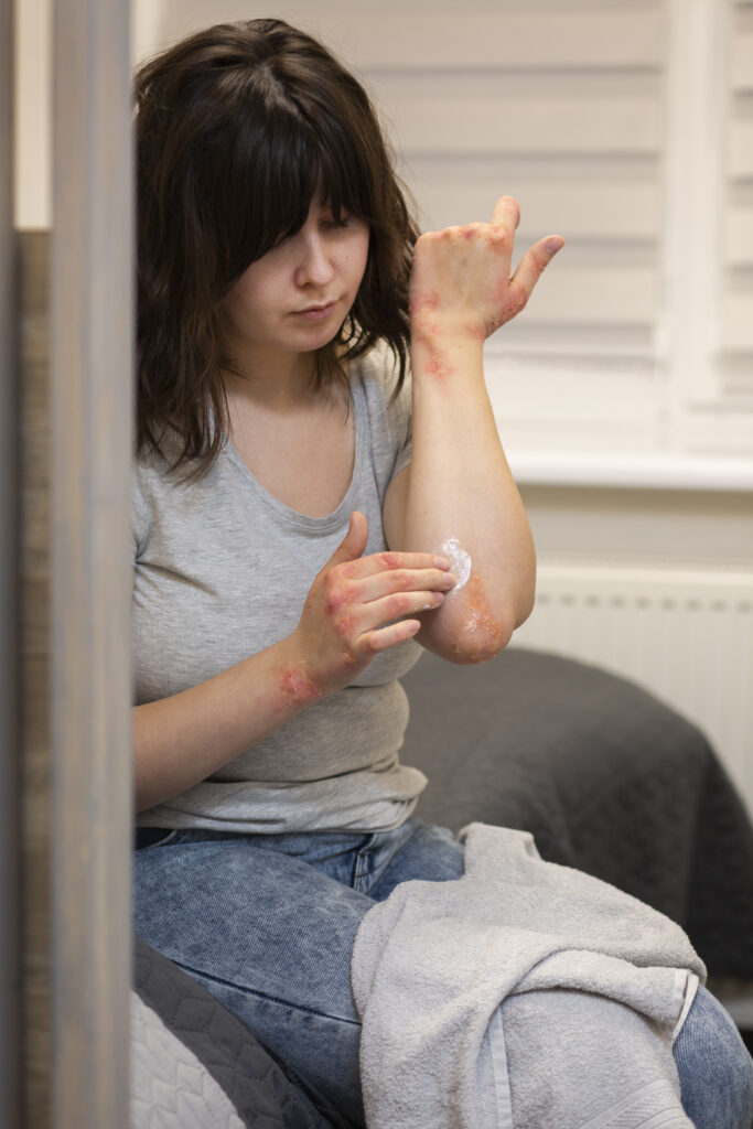 Psoriasis and Skin Allergy Treatment in Tirupati