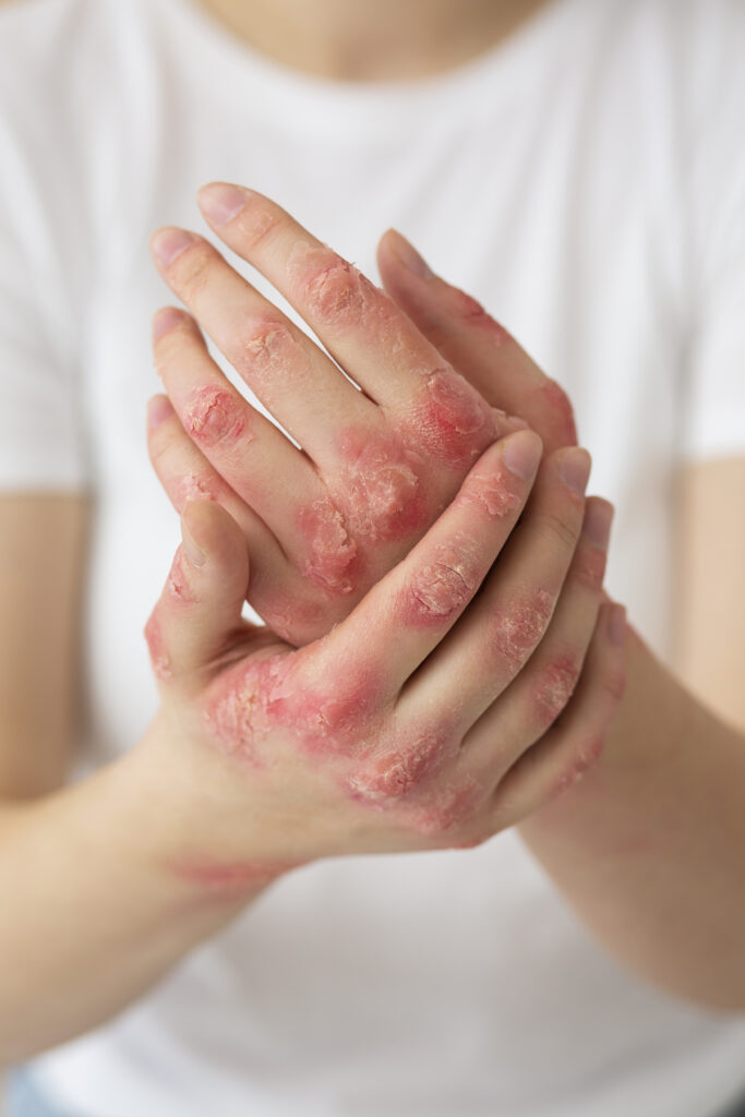 Psoriasis Redness and Swelling Cure in Kurnool