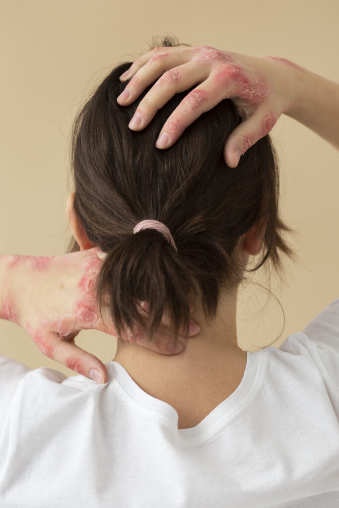 Clinical Psoriasis Care in Tirupati Skin Treatment