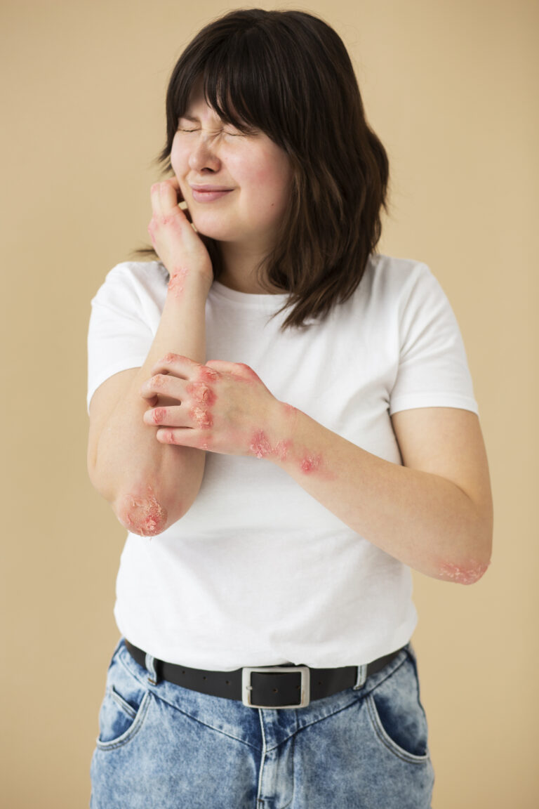 Psoriasis Healing Dermatologists in Vijayawada RK Ayurvedic