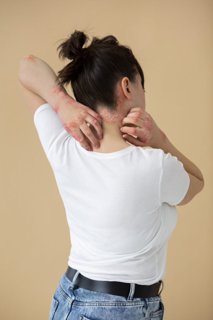 Psoriasis Detox Treatment in Tirupati Natural Healing