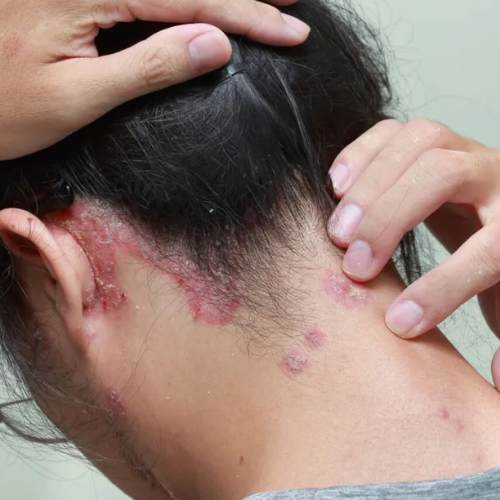 Scalp Psoriasis Ayurvedic Treatment in Vijayawada