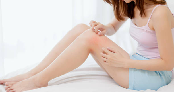 Lower leg of a woman with plaque psoriasis featuring raised, bordered crimson patches Seeks Treatment for Psoriasis.