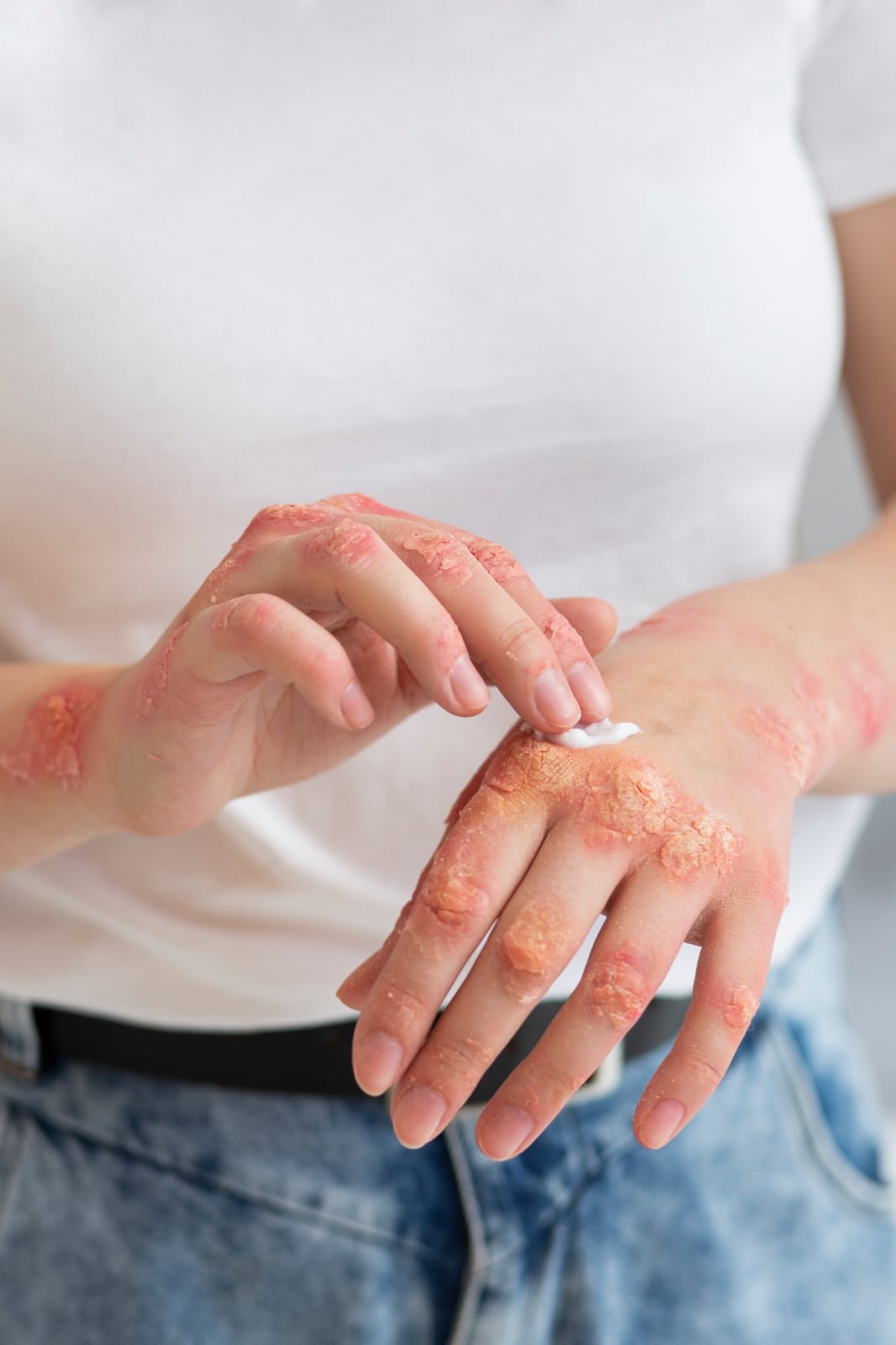 Woman's hand showing guttate psoriasis with small, droplet-shaped pink scaly spots.