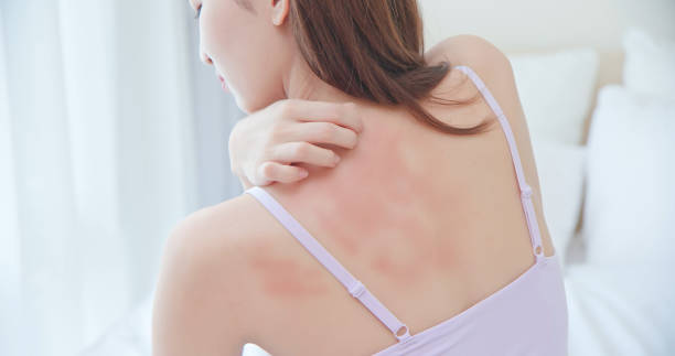 Woman in pink top scratches red back rash on bed. Red rash irritation on woman's back Seeks seek Treatment for Psoriasis