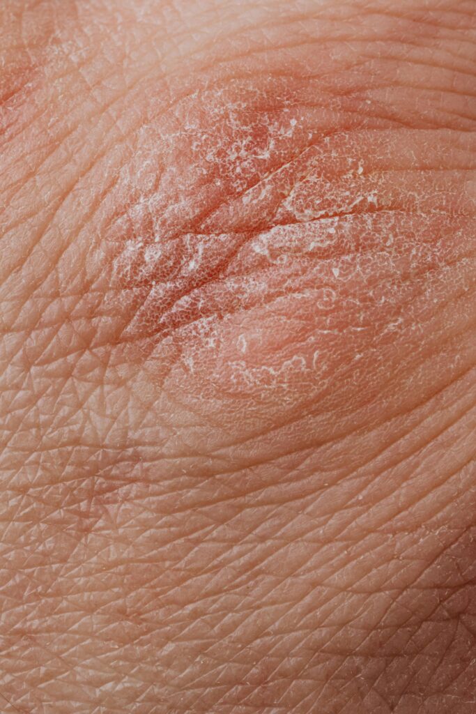 Silvery scales on red psoriasis patches on skin